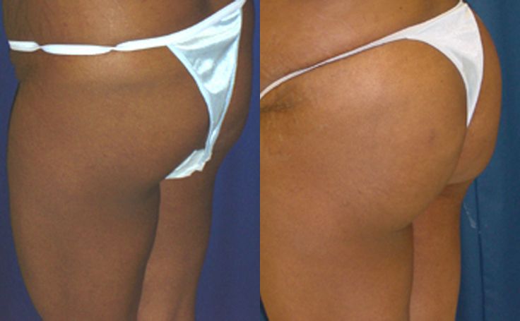 brazilian-butt-lift-before-after-a-154.jpeg