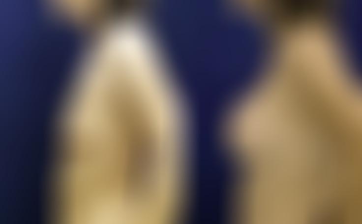 breast aug before and after 450 cc silicone breast implants side view