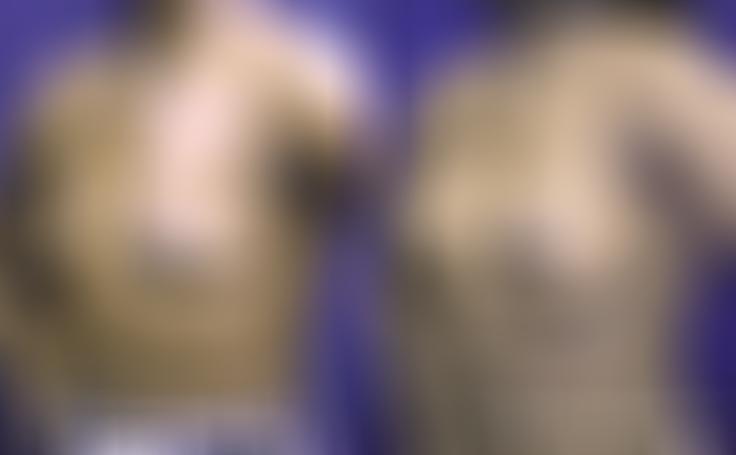 Before and after photo of an actual Breast Augmentation patient.