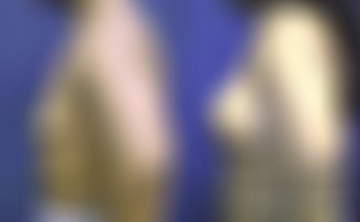 Before and after photo of an actual Breast Augmentation patient.