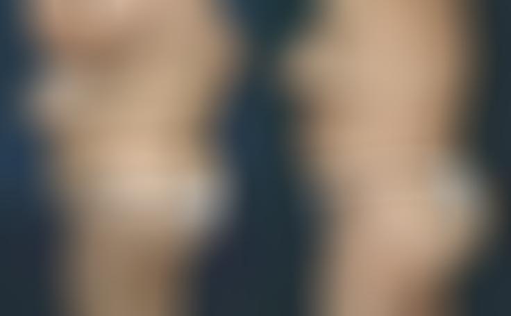 Before and after photo of an actual Body Lift patient.