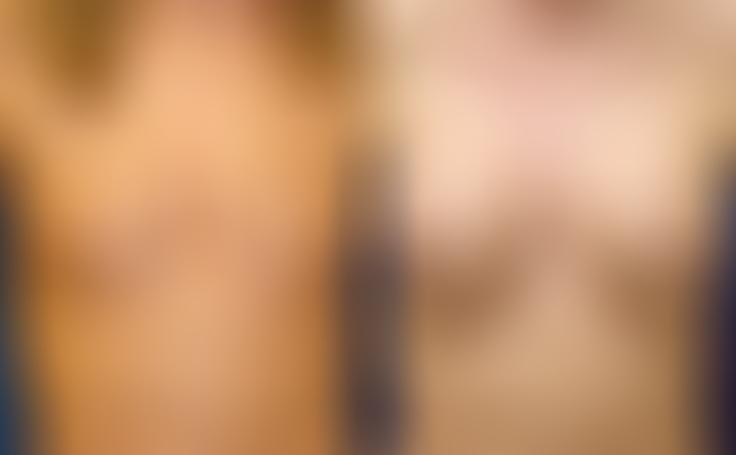Before and after photo of an actual Breast Augmentation patient.