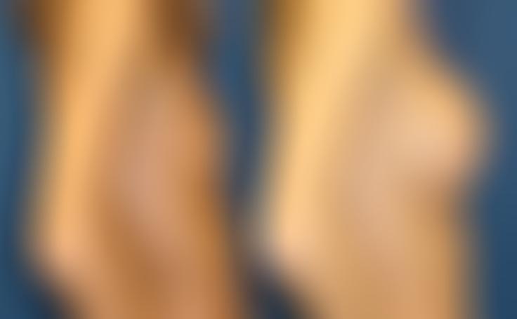 Before and after photo of an actual Breast Augmentation patient.