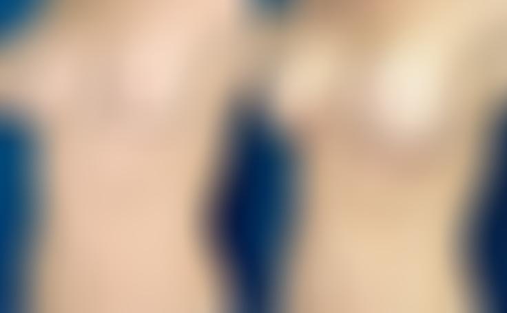 Before and after photo of an actual Breast Lift with Implants patient.