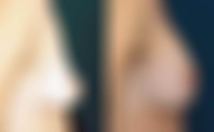 Before and after photo of an actual Breast Augmentation patient.