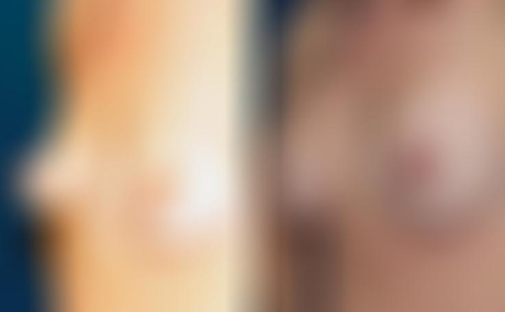 Before and after photo of an actual Breast Augmentation patient.
