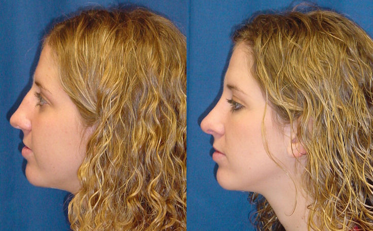 Rhinoplasty (Nose Job) Before & After Photos to remove