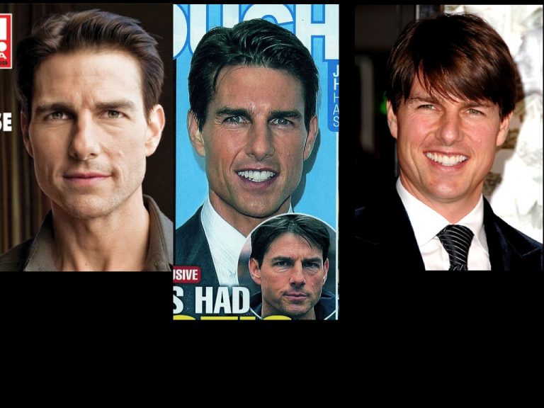 Tom Cruise plastic surgery - Did he have it? - Ricardo L. Rodriguez MD ...