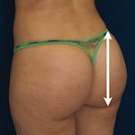 Can Men Get a Brazilian Butt Lift? 🧔🏻‍♂🍑 - Brazilian Butt Lift Guide