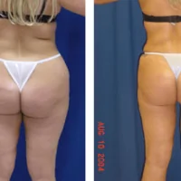 A collage of photos of a patient's lower body before & after a Liposuction procedure.