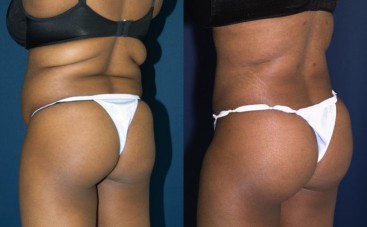 Buttock Injections: “Fat or Fiction?”