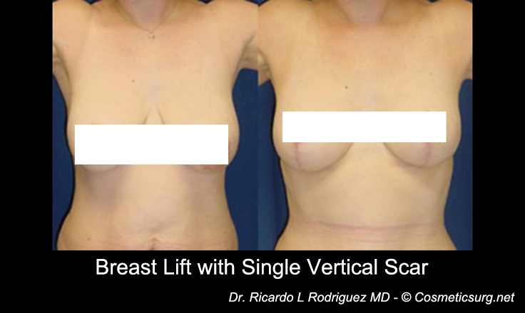 breast lift before and after scars