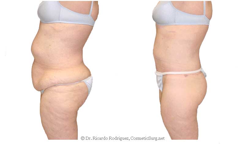 Avoid Complications After Your Body Lift Surgery