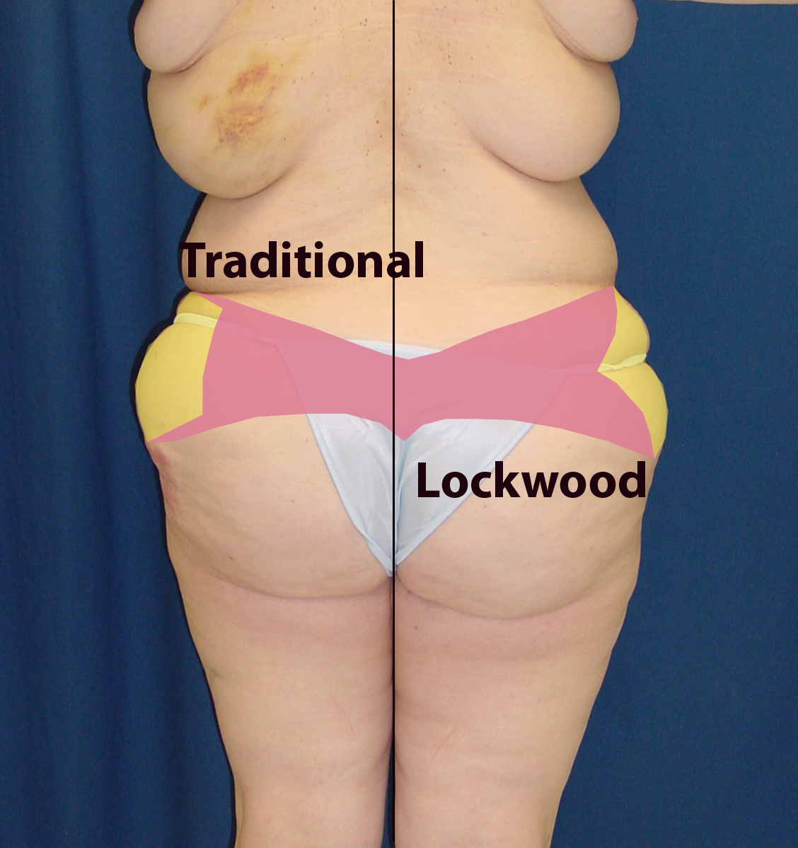 Body lift (Lower body lift, Belt lipectomy) - Dr. Rodriguez, Cosmeticsurg -  Baltimore