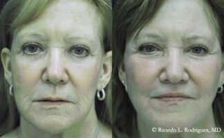 Before and after photos of a patient who had fat grafting to the upper and lower face, liposuction of the jowls, and a lip lift (frontal view).