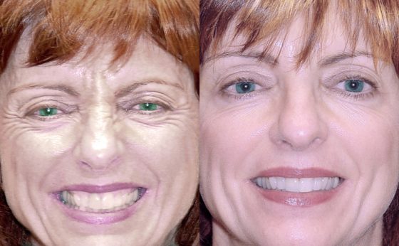 Before & After Botox injections around the eyes - Dr. Rodriguez