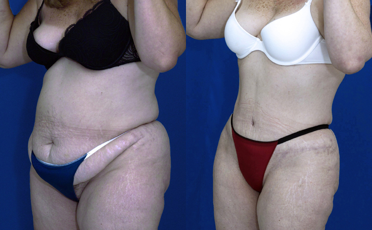 Before & After Abdominoplasty to remove hanging skin - Dr. Rodriguez,  Cosmeticsurg