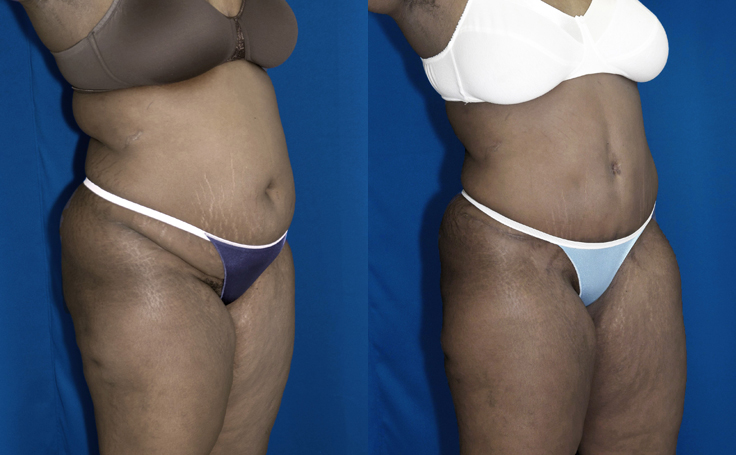 Before & After Abdominoplasty for flat stomach - Dr. Rodriguez