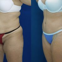 Before & After Abdominoplasty for loose skin - Dr. Rodriguez, Cosmeticsurg