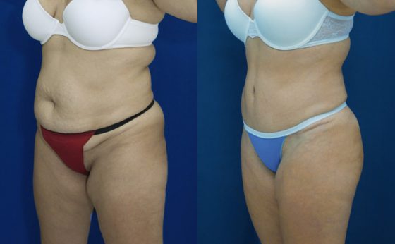 Before & After Tummy tuck patient in her 60's - Dr. Rodriguez, Cosmeticsurg