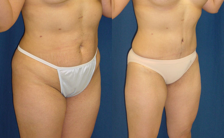 Before & After Lipo of flanks - Dr. Rodriguez, Cosmeticsurg