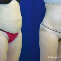 Before & After Tummy Tuck with lipo (3100 cc fat extracted) - Dr