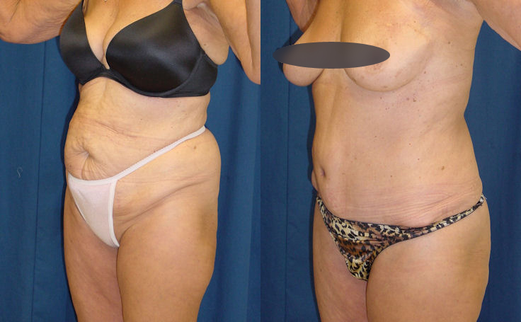 Before & After Tummy tuck patient in her 60's - Dr. Rodriguez, Cosmeticsurg