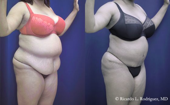 Before & After Tummy tuck patient in her 60's - Dr. Rodriguez, Cosmeticsurg
