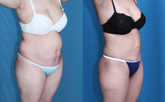 Before & After Tummy tuck with lipo to flanks and thighs - Dr. Rodriguez,  Cosmeticsurg
