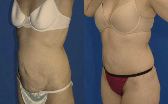 Before & After Abdominoplasty to remove hanging skin - Dr. Rodriguez,  Cosmeticsurg