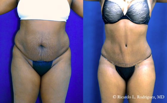 Before & After Lipo of flanks - Dr. Rodriguez, Cosmeticsurg