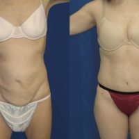 Before & After Abdominoplasty to remove hanging skin - Dr. Rodriguez,  Cosmeticsurg