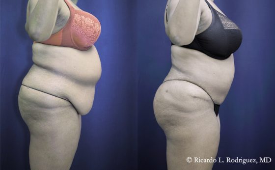 Before & After Abdominoplasty and liposuction - Dr. Rodriguez