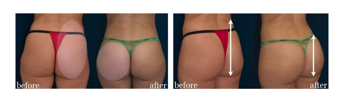 BBL before and after images showing waist hip ratio improvement, not just size.