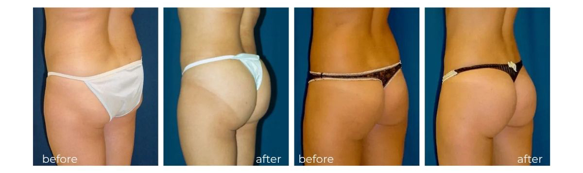 BBL before and after images showing natural contour and projection improvement.