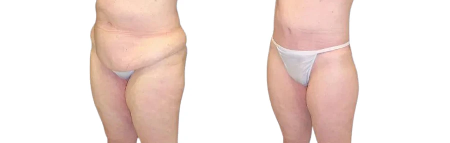body lift patient before and after surgery