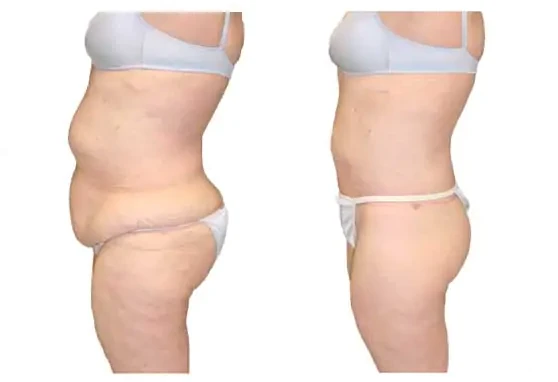 patient profile before and after a body lift with Dr. Ricardo Rodriguez