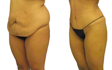 Side view of a patient before and after her extended tummy tuck