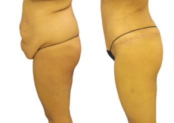 Side view of a patient before and after her extended tummy tuck