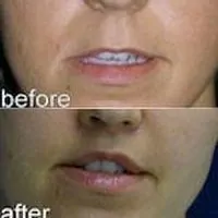 A collage of photos of a patient's mouth, showing her lips before and after a lip lift procedure.