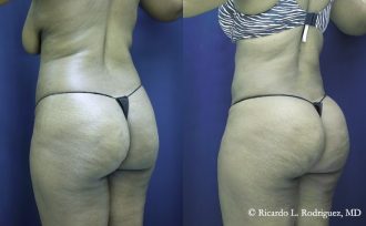 Brazilian Butt Lift (BBL) - Dr. Rodriguez, Cosmeticsurg in Baltimore