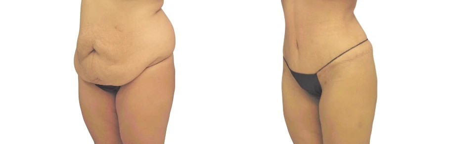 patient before and after a body lift alternative procedure, the extended tummy tuck