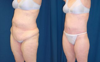 Belt Lipectomy vs. Abdominoplasty for a Complete Tummy Transformation