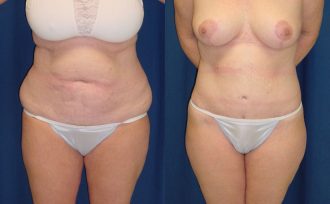 Before & After Belt Lipectomy Photos