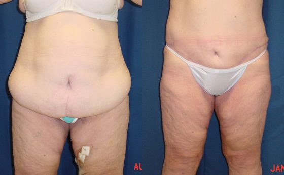 Belt lipectomy or lower body lift: how to get rid of loose skin