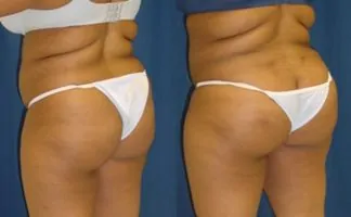 Before and after photo of an actual Brazilian Butt Lift patient.