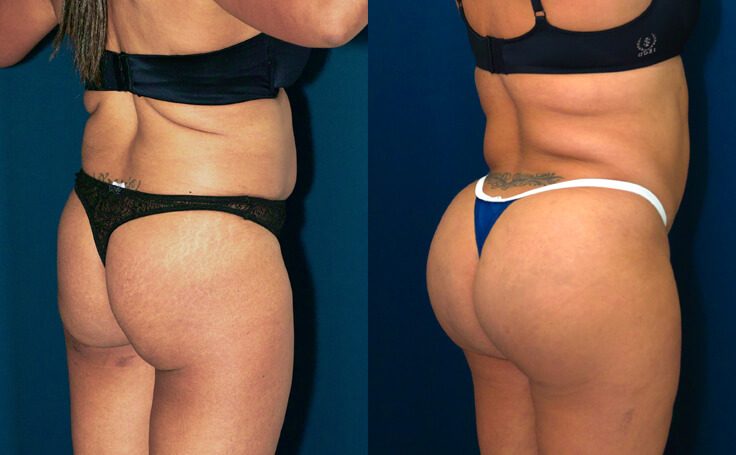 Liposuction 360 with Fat Transfer to the Buttocks (Brazilian Butt Lift - BBL )