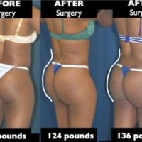 Will my Brazilian Butt Lift (BBL) go away if I lose weight? - Dr. Pancholi