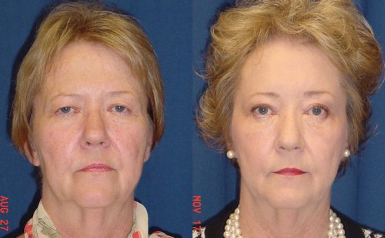 Brow Lift Before And After Photos Ricardo L Rodriguez Md Baltimore 2591