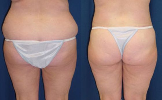 Before & After Posterior butt lift after weight loss - Dr. Rodriguez,  Cosmeticsurg